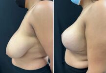 before and after breast reduction left side view female patient case 28751