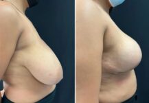before and after breast reduction right side view female patient case 28751
