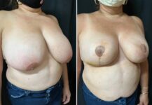 before and after breast reduction right angle view female patient case 28757