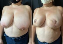 before and after breast reduction left angle view female patient case 28757