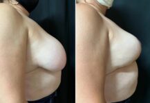 before and after breast reduction right side view female patient case 28757