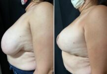 before and after breast reduction left side view female patient case 28757