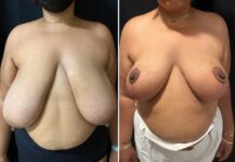 before and after breast reduction front view female patient case 28764