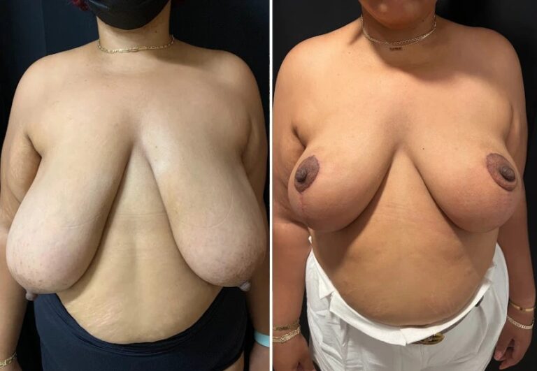 before and after breast reduction front view female patient case 28764