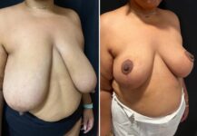before and after breast reduction right angle view female patient case 28764