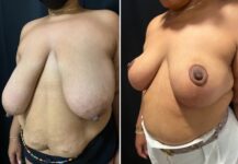 before and after breast reduction left angle view female patient case 28764