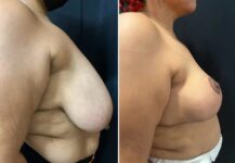 before and after breast reduction right side view female patient case 28764