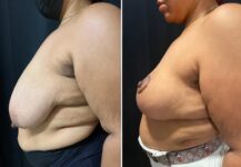 before and after breast reduction left side view female patient case 28764