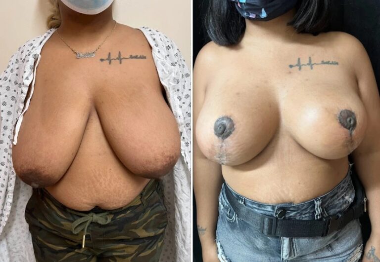 before and after breast reduction front view female patient case 28770