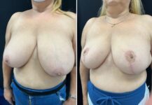 before and after breast reduction left angle view female patient case 28772