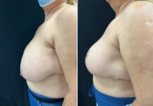 before and after breast reduction side view female patient case 28772