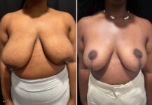 before and after breast reduction front view female patient case 28776