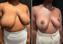 before and after breast reduction right angle view female patient case 28776