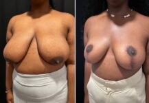 before and after breast reduction left angle view female patient case 28776