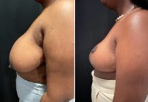 before and after breast reduction left side view female patient case 28776