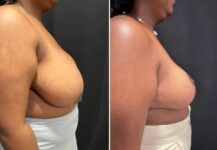 before and after breast reduction right side view female patient case 28776