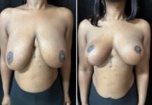 before and after breast reduction front view female patient case 28783