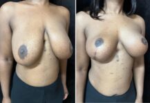 before and after breast reduction right angle view female patient case 28783