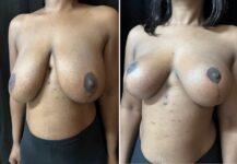 before and after breast reduction left angle view female patient case 28783