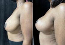 before and after breast reduction left side view female patient case 28783