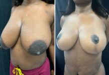 before and after breast reduction left angle view female patient case 28717