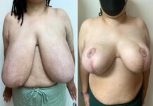 before and after breast reduction front view female patient case 28790