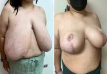 before and after breast reduction angle view female patient case 28790