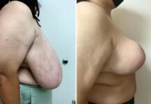 before and after breast reduction side view female patient case 28790