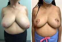 before and after breast reduction front view female patient case 28794