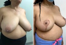 before and after breast reduction right angle view female patient case 28794