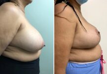 before and after breast reduction side view female patient case 28794