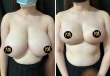 before and after breast reduction front view female patient case 28798