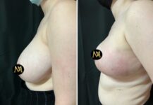 before and after breast reduction left side view female patient case 28798