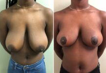 before and after breast reduction front view female patient case 28838