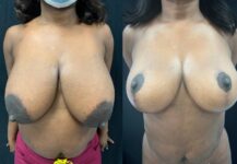 before and after breast reduction front view female patient case 29402