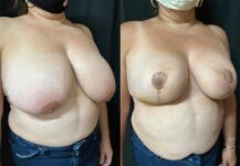 before and after breast reduction angle view female patient case 29488