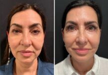 before and after facelift NYC front view female patient case 28657