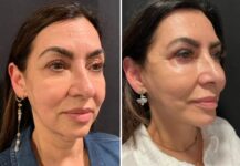 before and after facelift NYC right angle view female patient case 28657