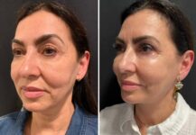 before and after facelift NYC left angle view female patient case 28657