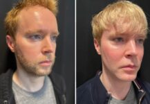 before and after facial implants NYC right angle view male patient case 28661