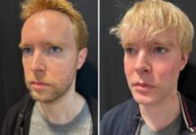 before and after facial implants NYC left angle view male patient case 28661