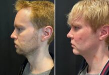 before and after facial implants NYC left side view male patient case 28661