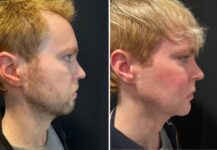 before and after facial implants NYC right side view male patient case 28661