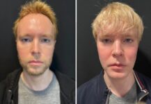 before and after facial implants NYC front view male patient case 28661