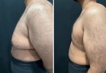 before and after gynecomastia procedure left side view case 28884