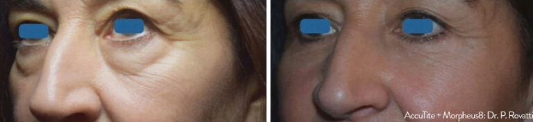 before and after Morpheus8 face view case 28846