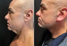 before and after neck lift NYC left side view male patient case 28668