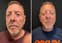 before and after neck lift NYC front view male patient case 28671