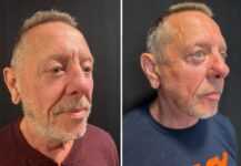 before and after neck lift NYC right angle view male patient case 28671