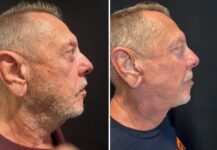 before and after neck lift NYC right side view male patient case 28671